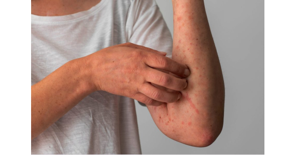 L Orticaria Un Eruzione Cutanea Medicinapro It