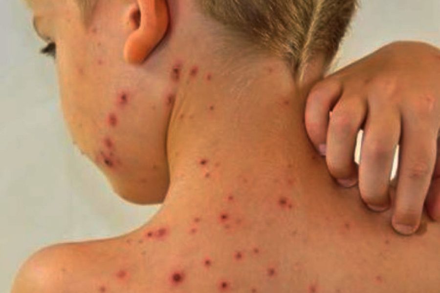 L'impetigine: un'infezione cutanea che colpisce soprattutto i bambini.