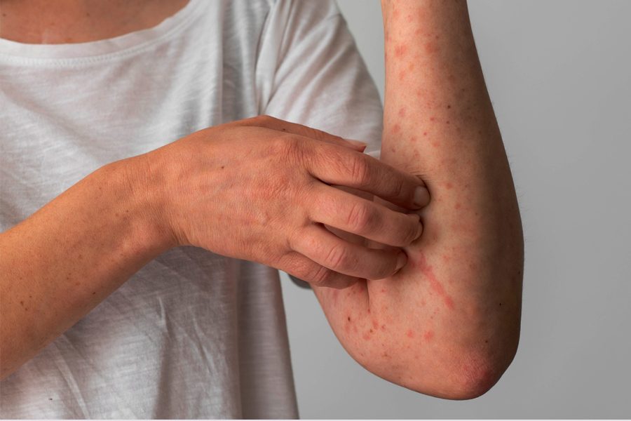 L'orticaria: un'eruzione cutanea che colpisce circa il 20% della popolazione