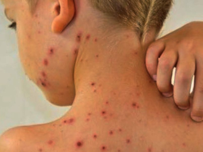 L'impetigine: un'infezione cutanea che colpisce soprattutto i bambini.