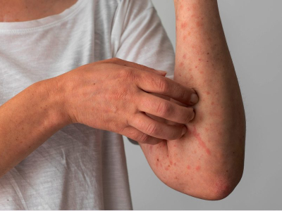 L'orticaria: un'eruzione cutanea che colpisce circa il 20% della popolazione